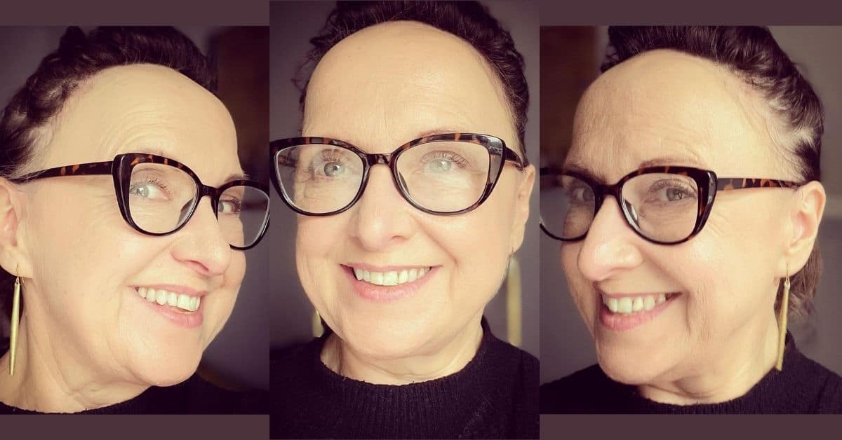 Frontal Fibrosing Alopecia Elizabeth Carr-Ellis